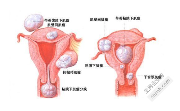 泰国试管婴儿如何预防宫外孕？