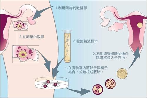 正规二代试管婴儿公司-试管婴儿中使用什么药物来支持怀孕？