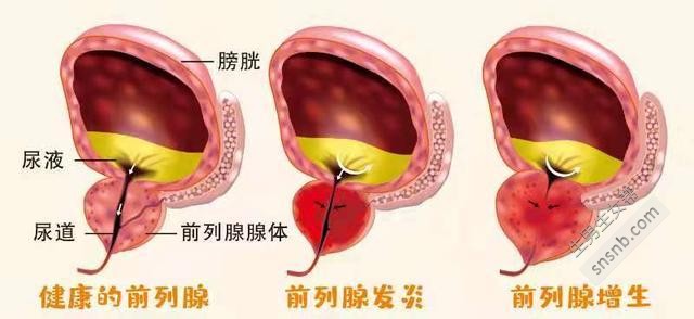 前列腺增生是非常危险的! 有很好的方法来治疗它